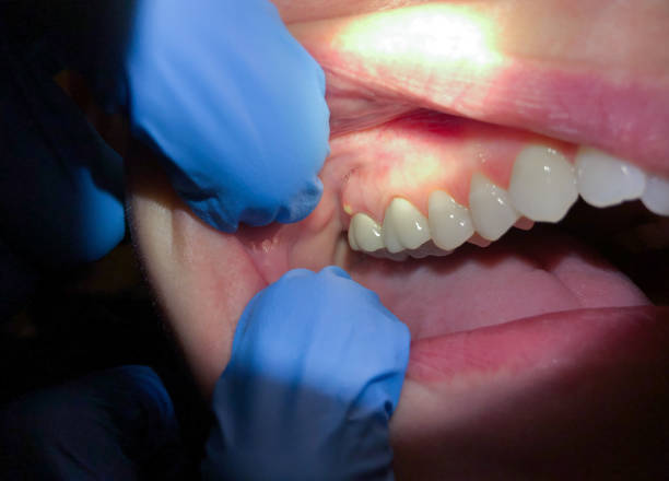 Best Emergency Wisdom Teeth Removal in Dublin, GA