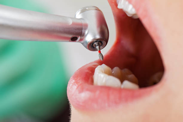 Best Emergency Root Canal Treatment in Dublin, GA